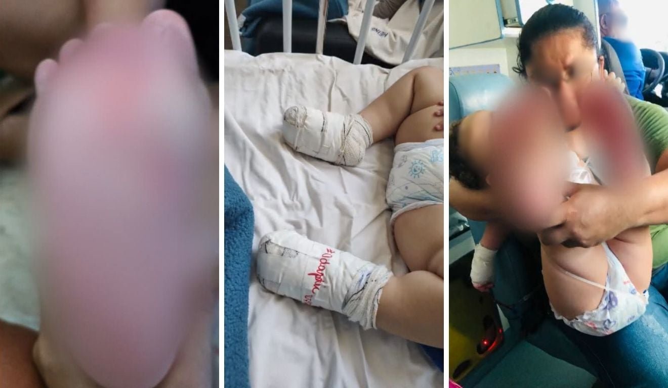 Beb&ecirc; sofre queimaduras nos p&eacute;s ap&oacute;s recrea&ccedil;&atilde;o em creche na Serra