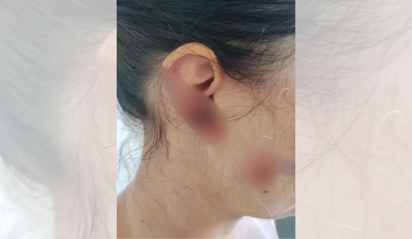 Mulher tem parte da orelha arrancada em briga com ex do marido na Serra