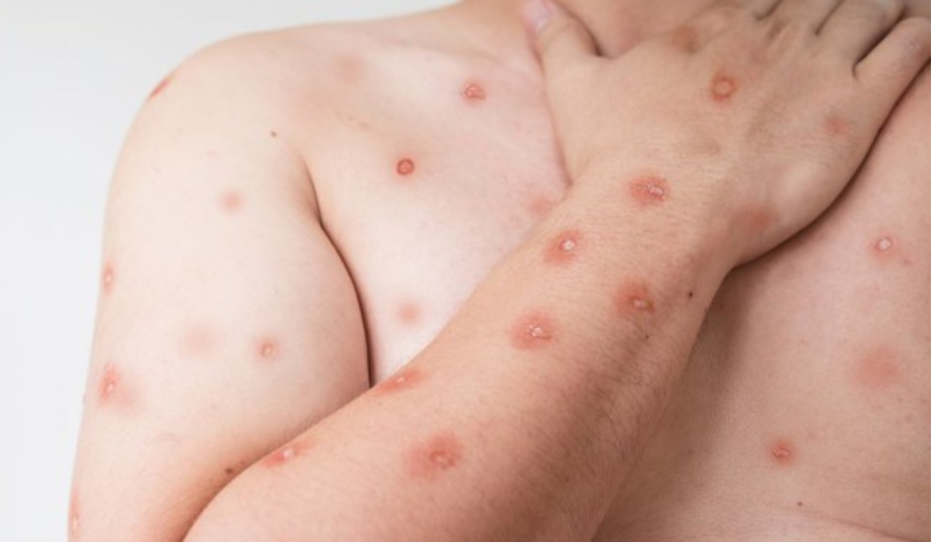 ES registra segundo caso de mpox e seis seguem em investiga&ccedil;&atilde;o