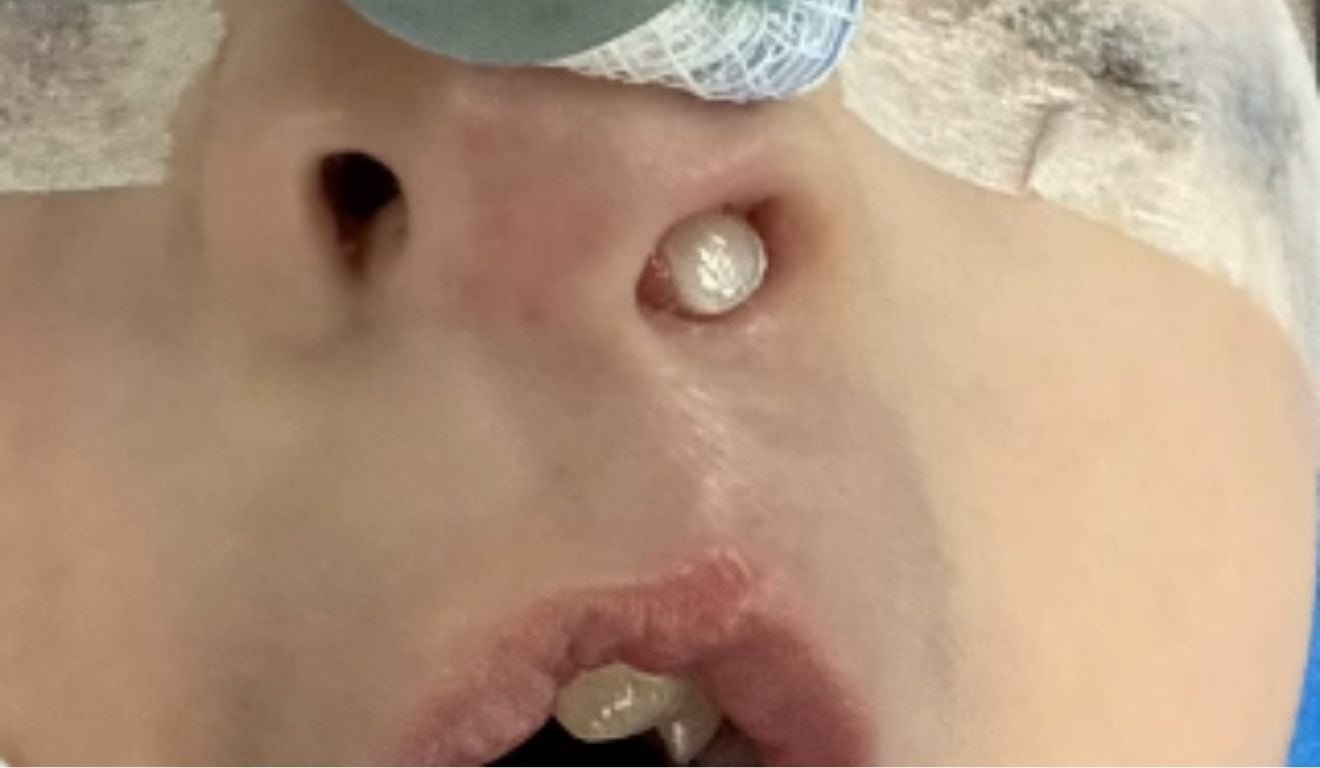 Crian&ccedil;a de 3 anos passa por cirurgia ap&oacute;s dente crescer dentro do nariz