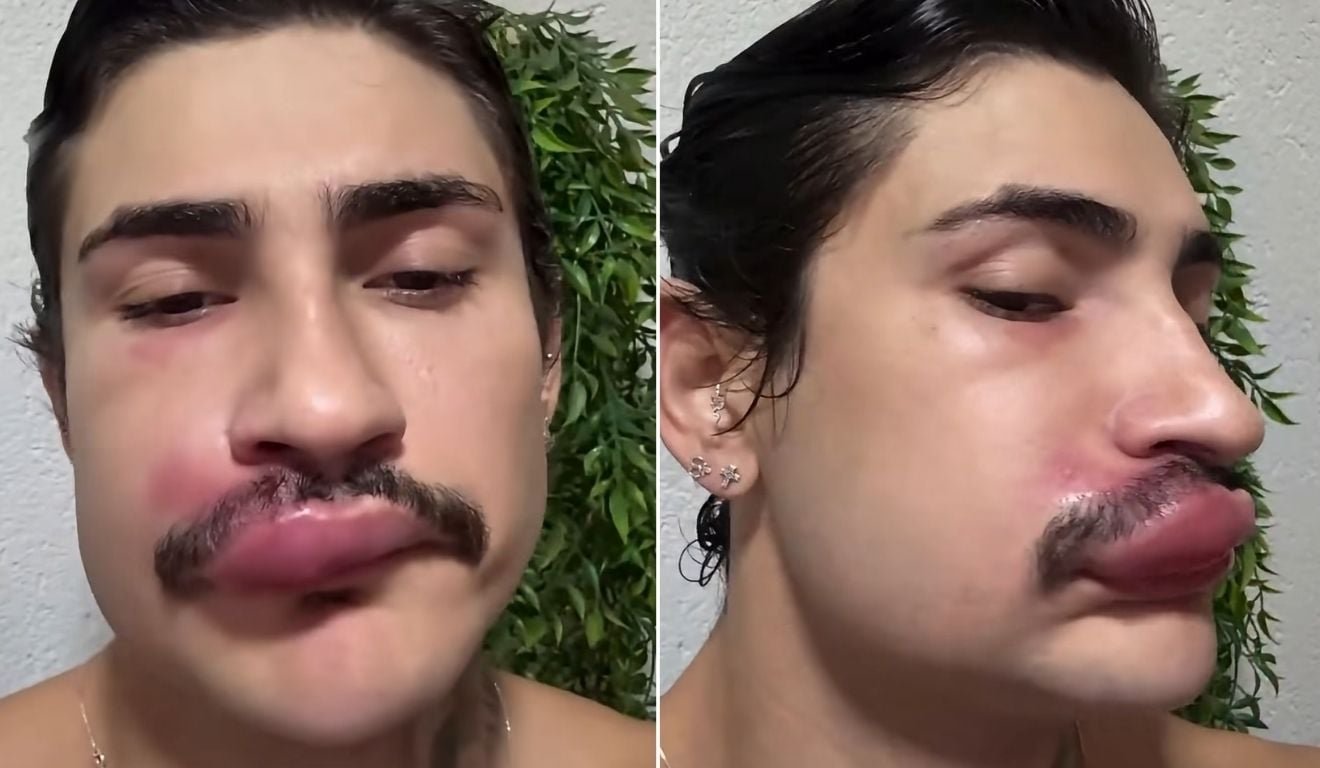 Influenciador &eacute; internado ap&oacute;s espremer espinha no &ldquo;tri&acirc;ngulo da morte&rdquo;; entenda