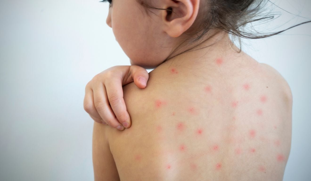 Guarapari emite alerta de aumento de casos de catapora; veja sintomas e preven&ccedil;&atilde;o