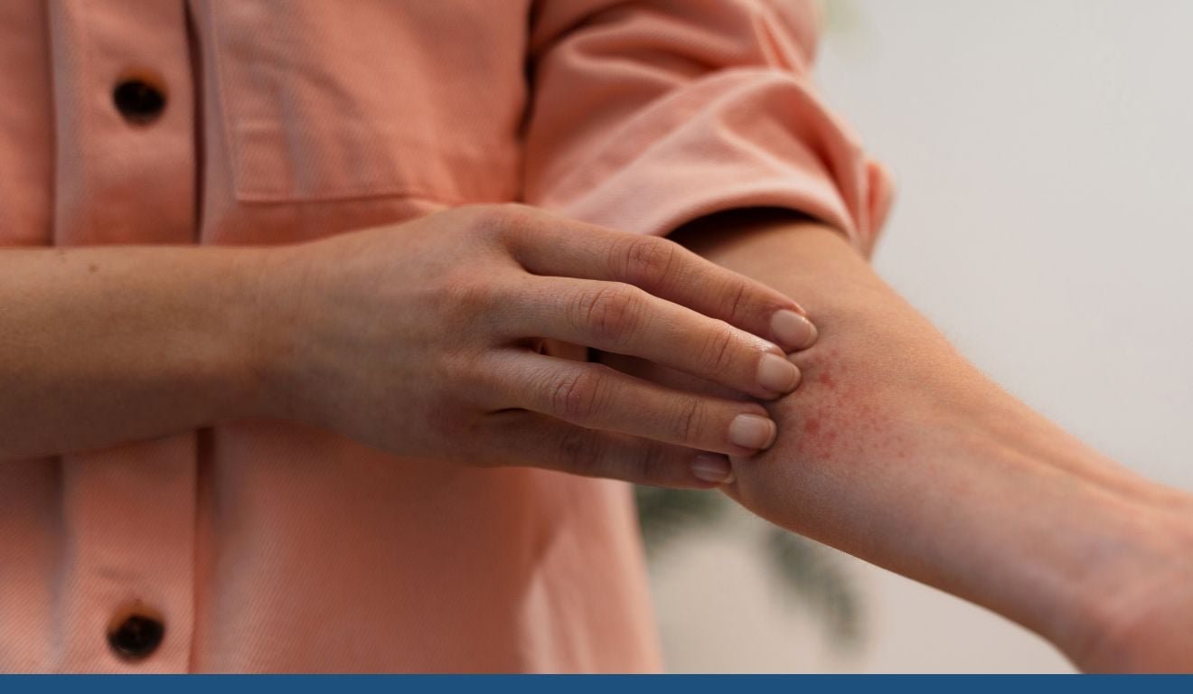Coceira que n&atilde;o passa? Veja os sinais e gatilhos da dermatite at&oacute;pica
