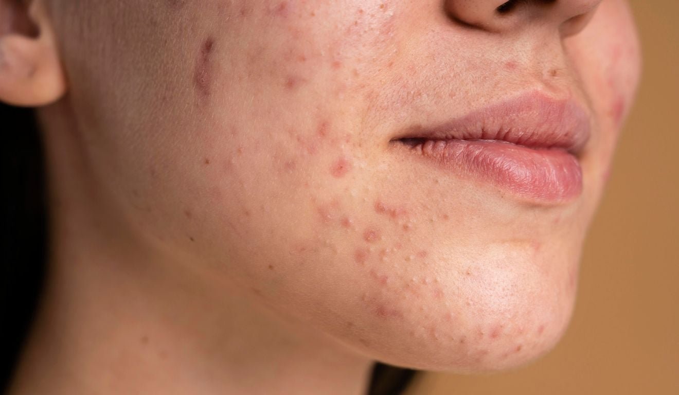 Acne adulta feminina: por que as espinhas persistem ap&oacute;s os 25 anos?